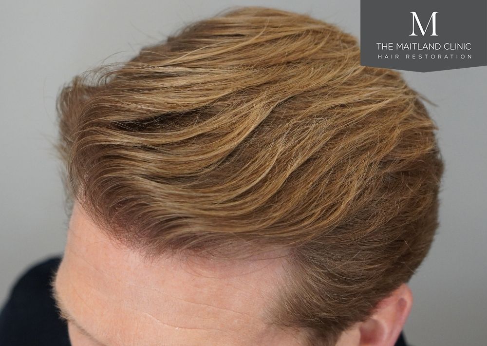 1956 grafts by FUE