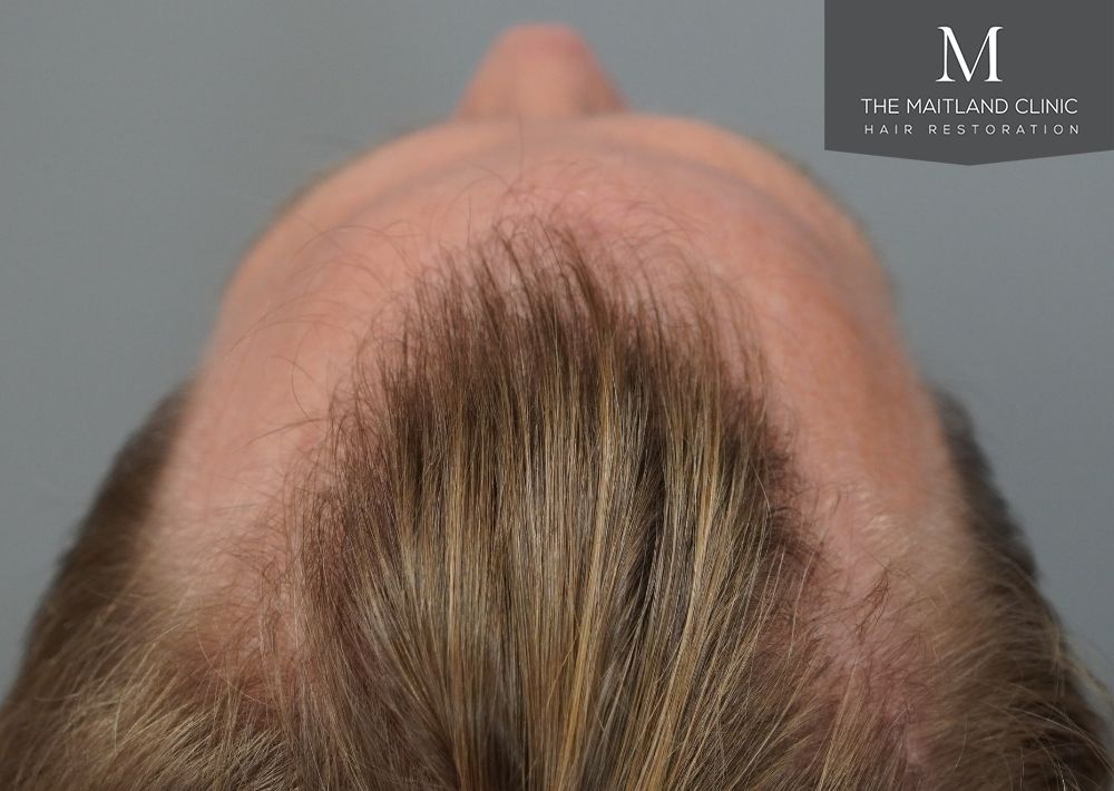 1956 grafts by FUE