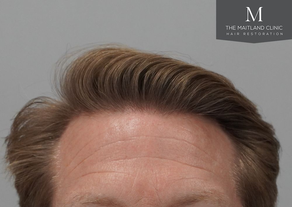 1956 grafts by FUE