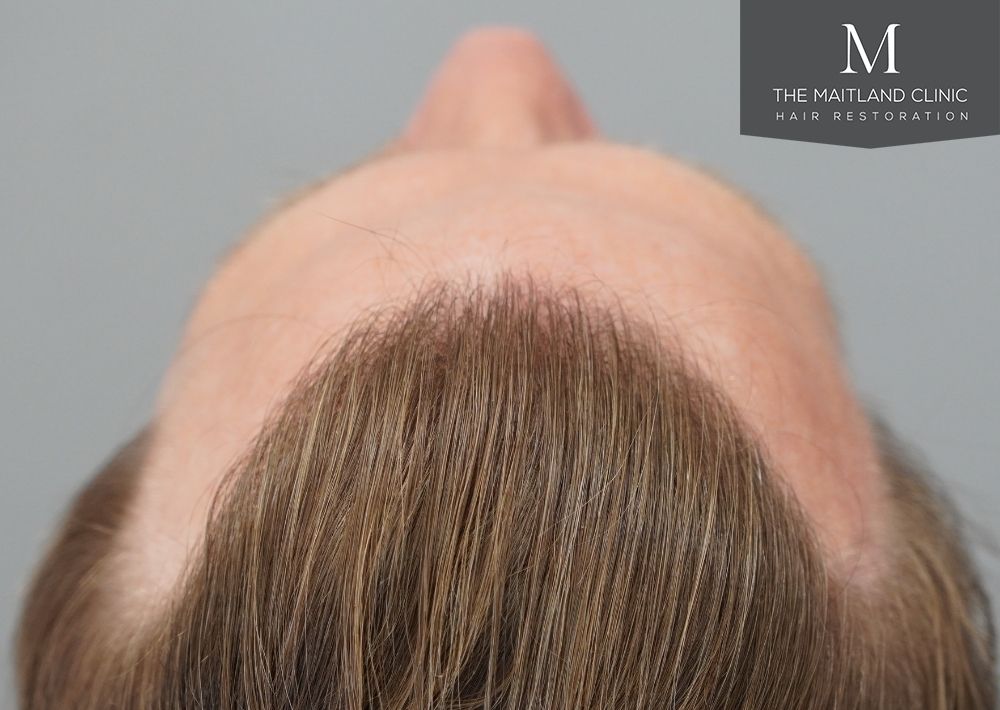 1956 grafts by FUE