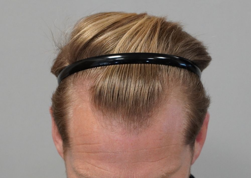 1956 grafts by FUE