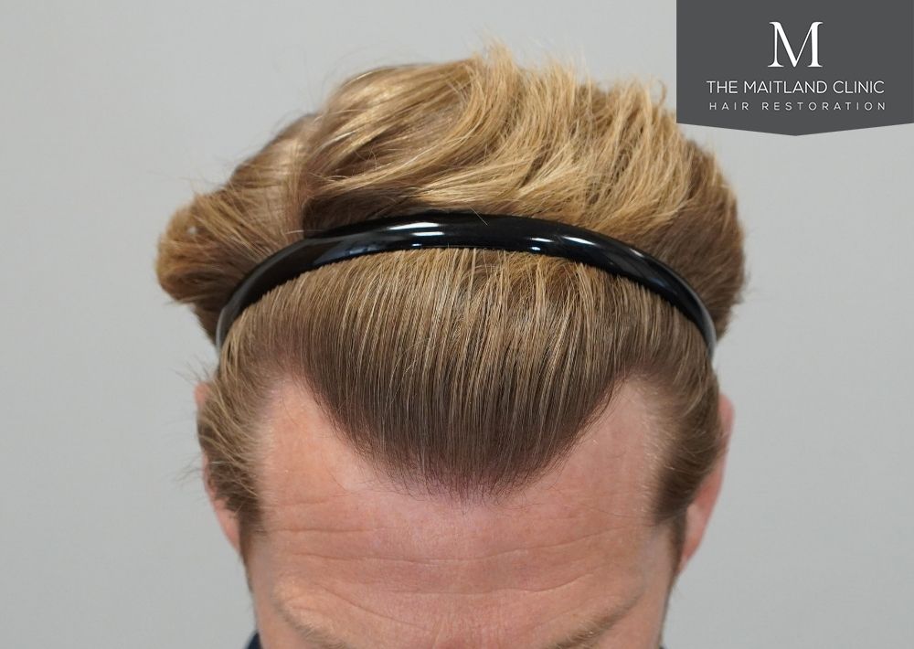1956 grafts by FUE