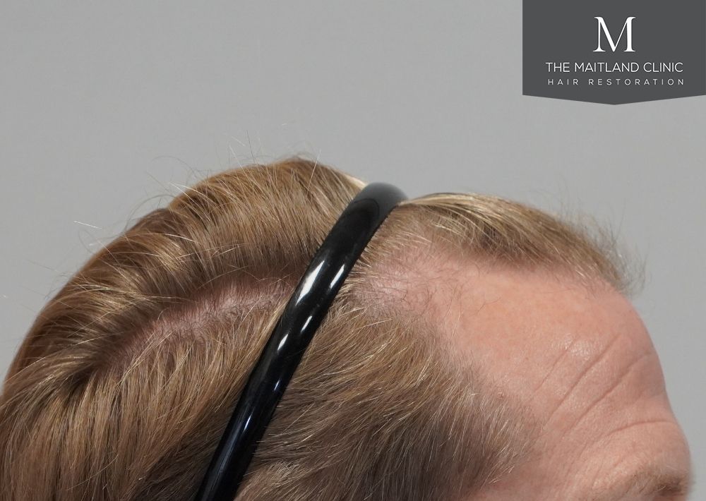1956 grafts by FUE