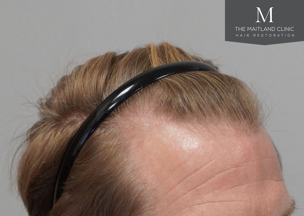 1956 grafts by FUE