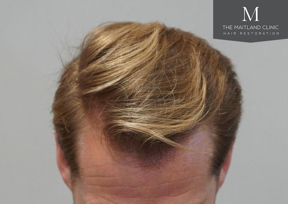 1956 grafts by FUE