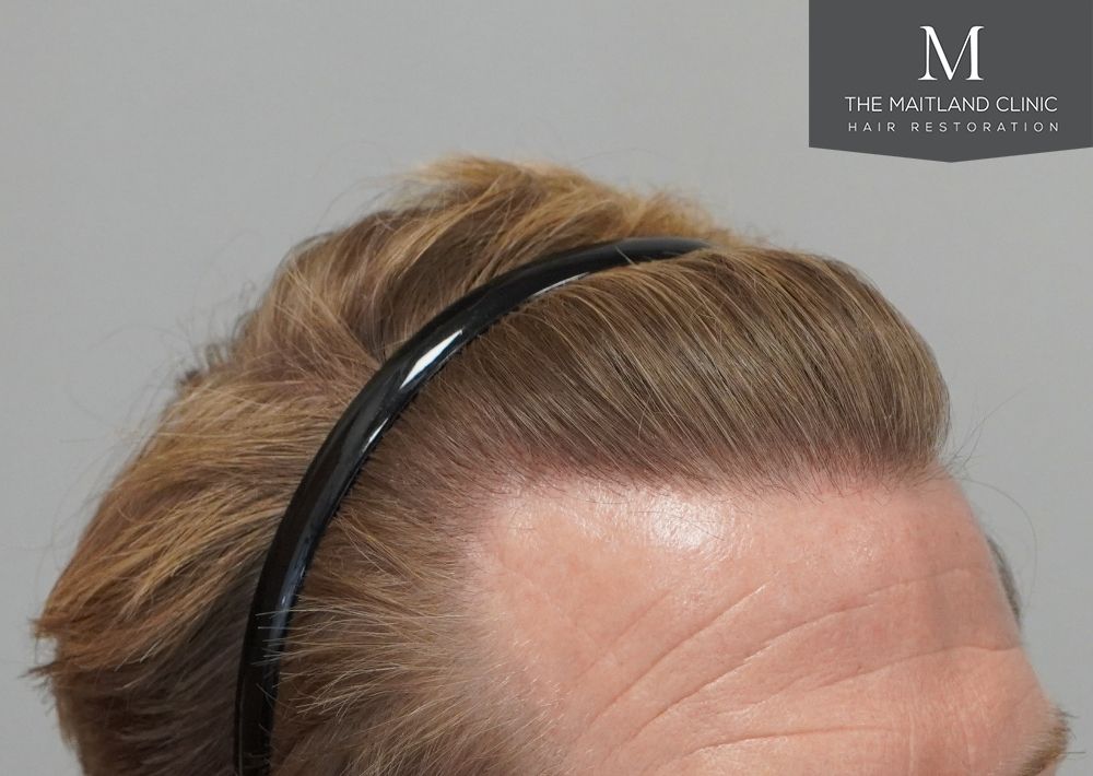 1956 grafts by FUE