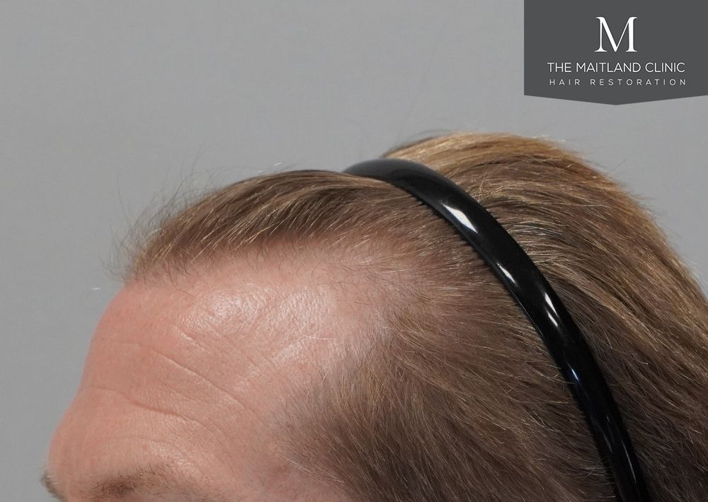 1956 grafts by FUE