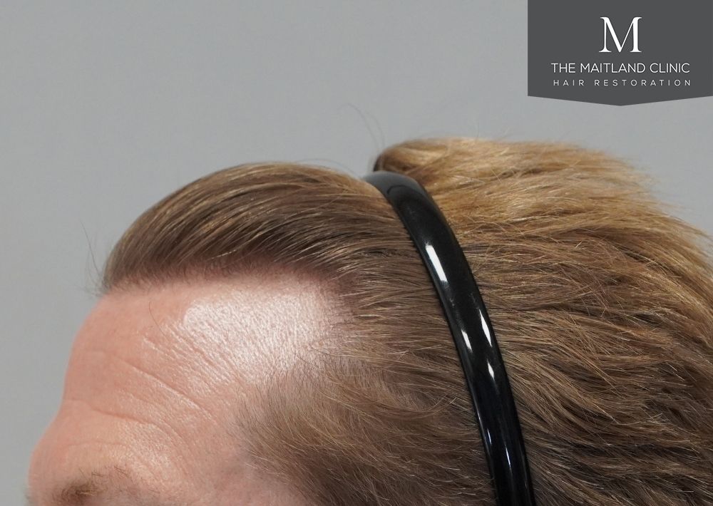 1956 grafts by FUE