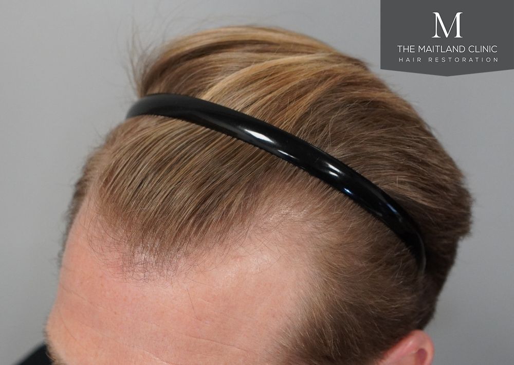 1956 grafts by FUE