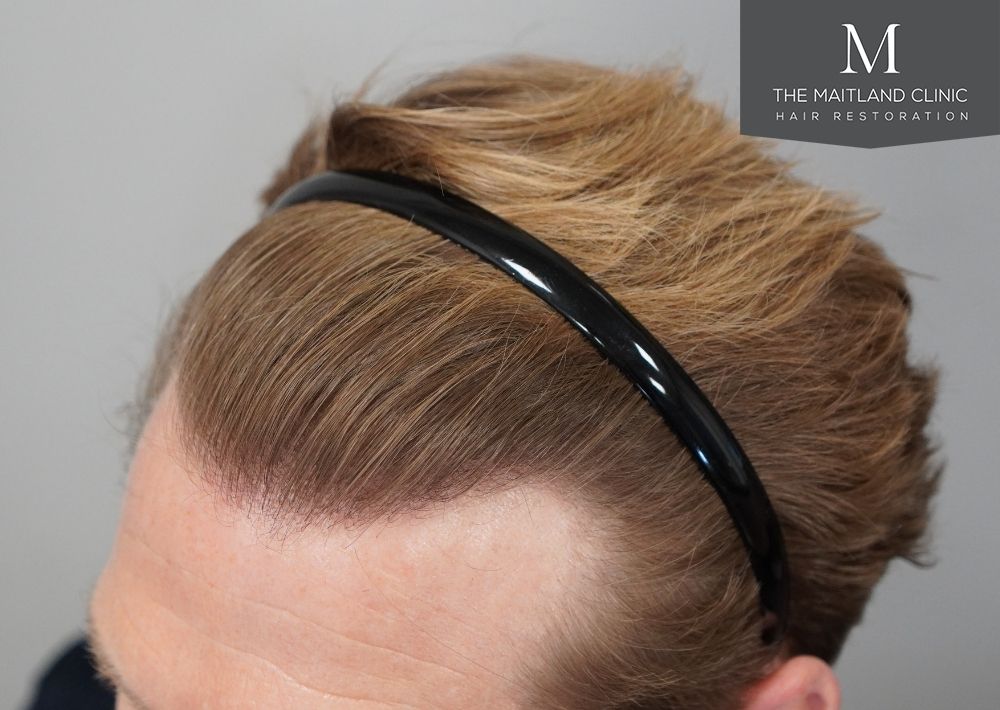 1956 grafts by FUE