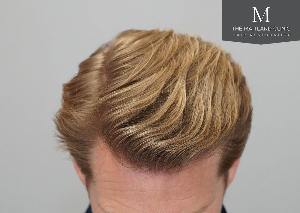 1956 grafts by FUE