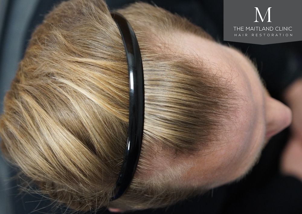 1956 grafts by FUE