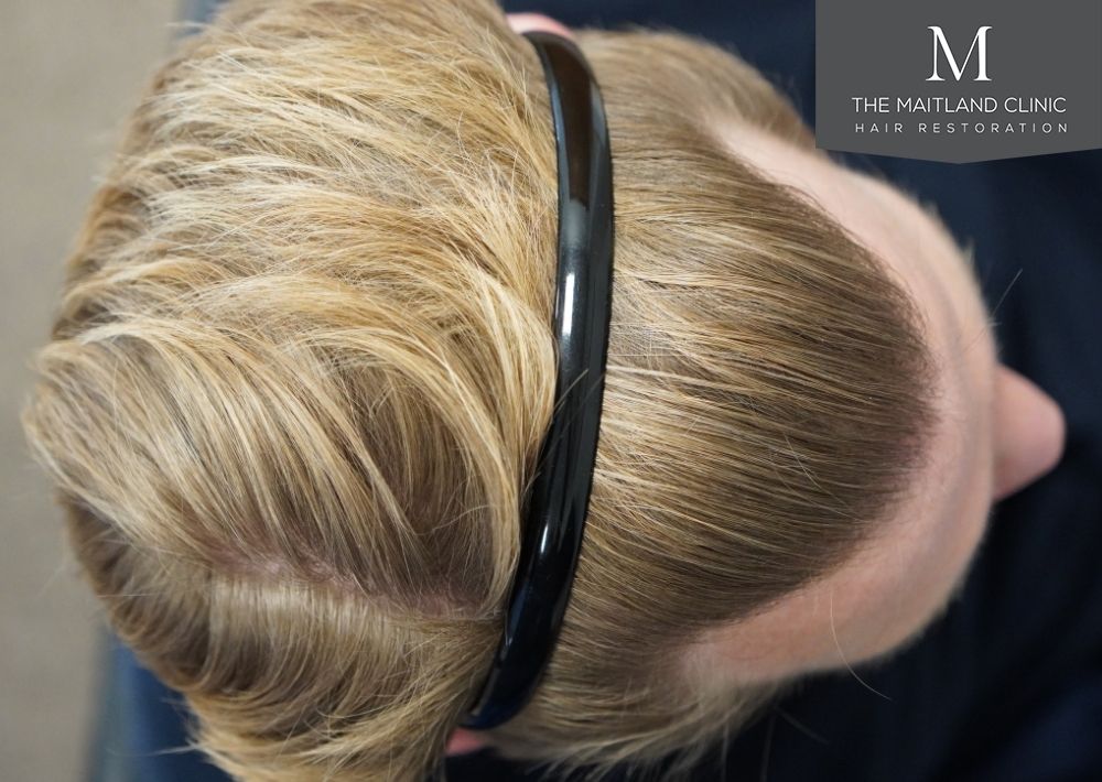 1956 grafts by FUE