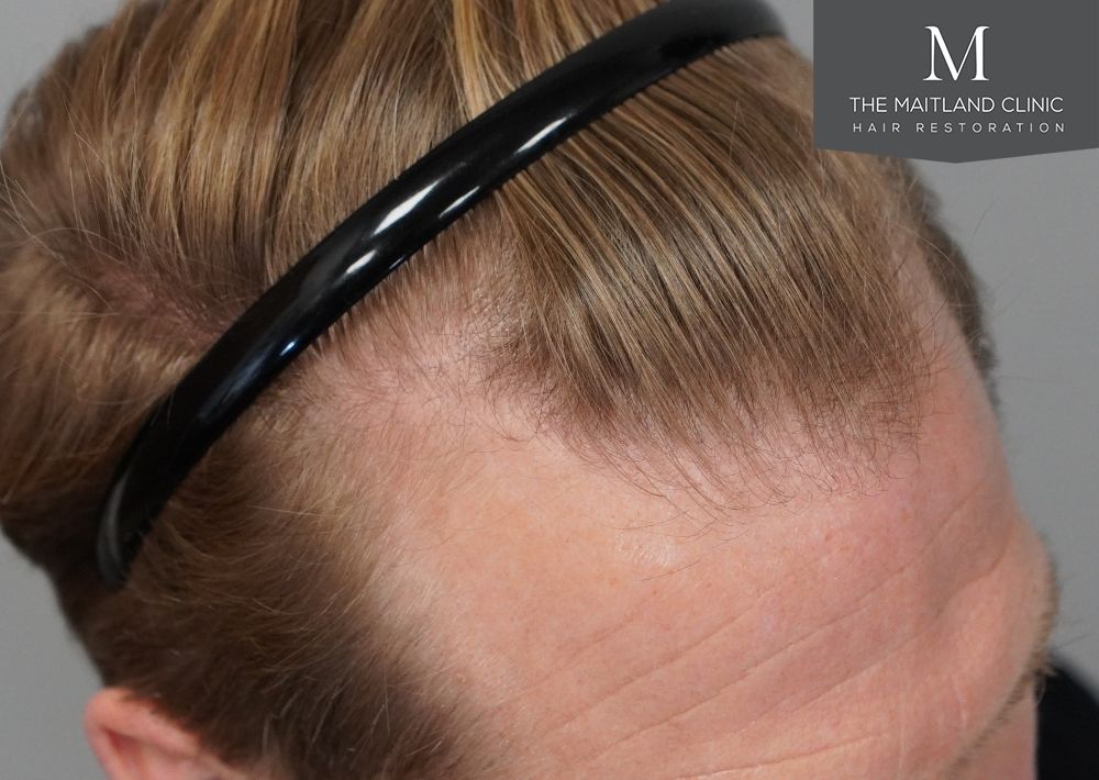 1956 grafts by FUE
