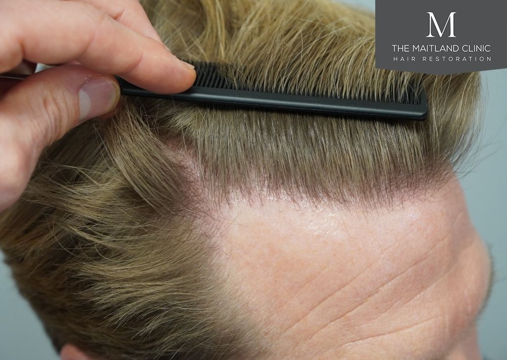 1956 grafts by FUE