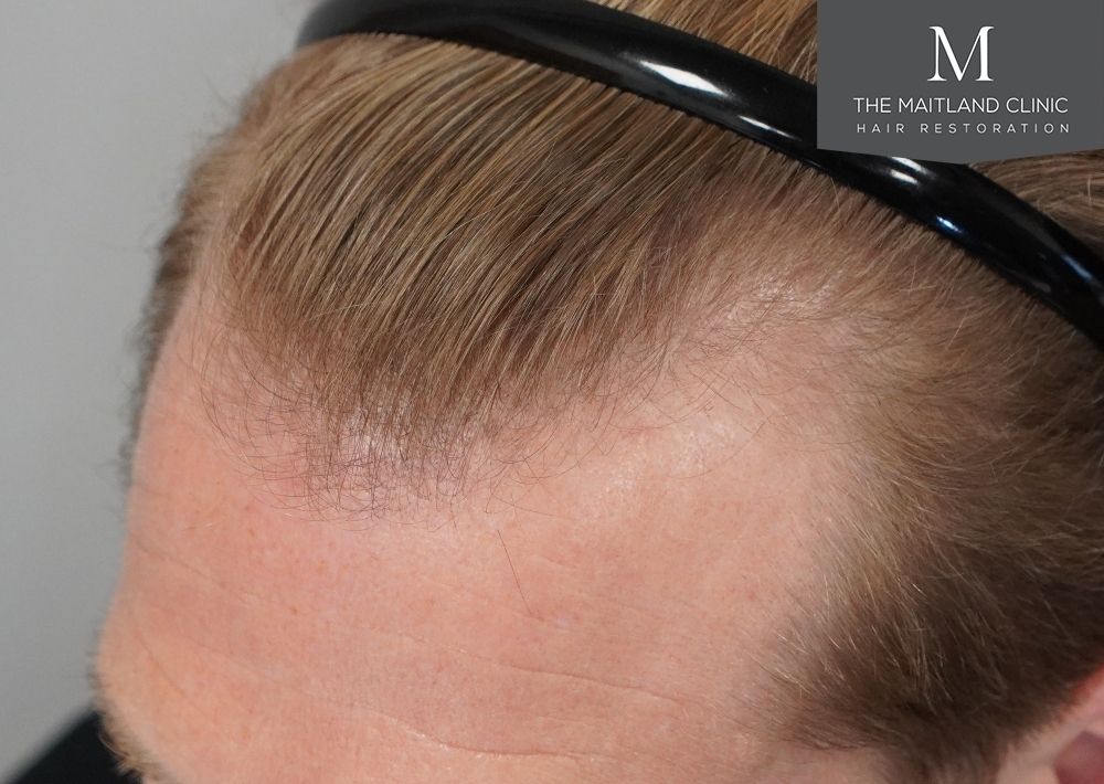 1956 grafts by FUE