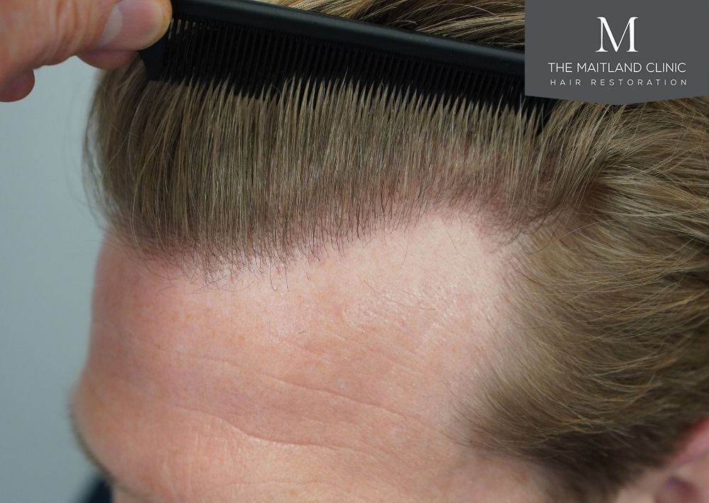 1956 grafts by FUE