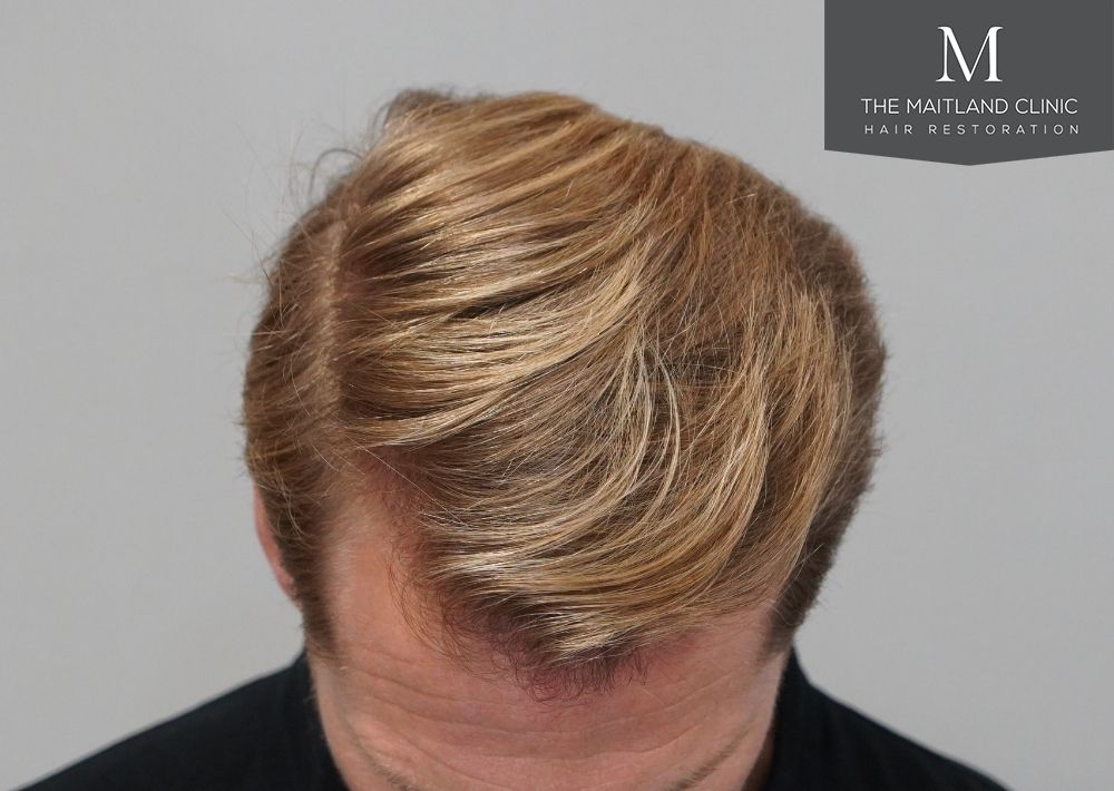 1956 grafts by FUE