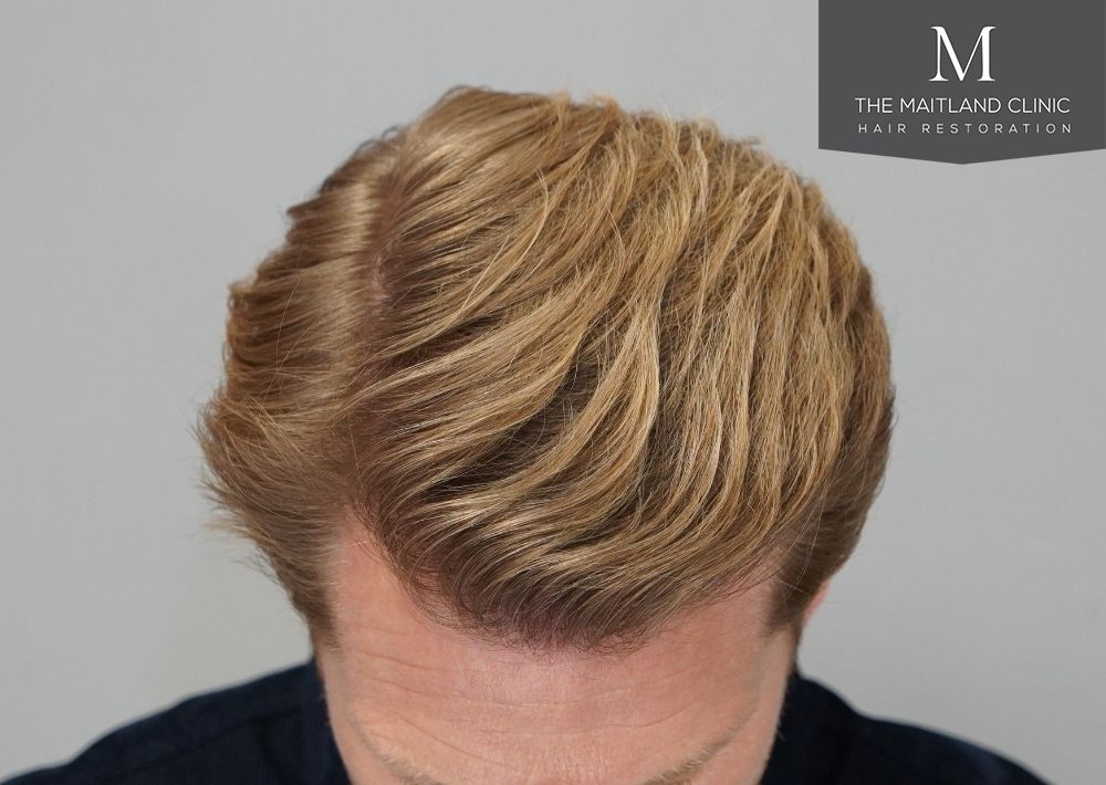 1956 grafts by FUE