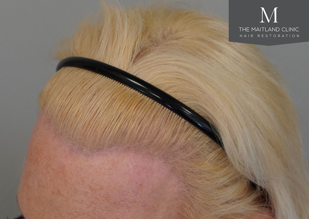 2628 grafts by FUT