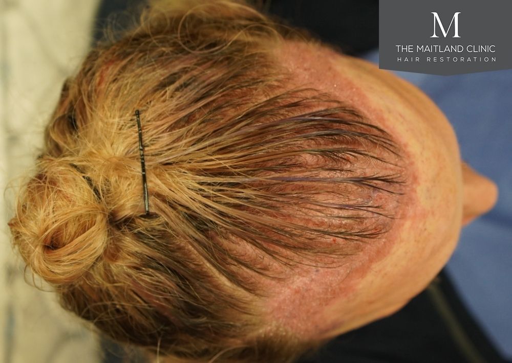 2628 grafts by FUT