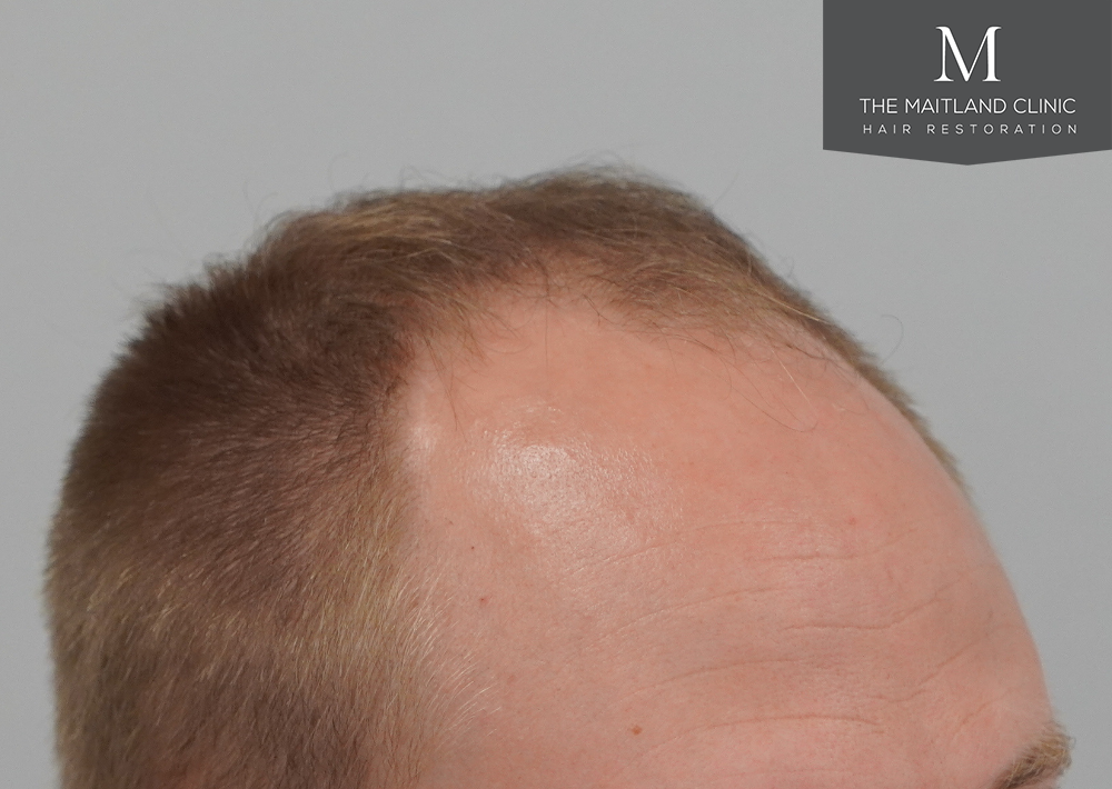 4566 grafts by FUE