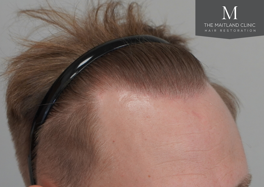4566 grafts by FUE