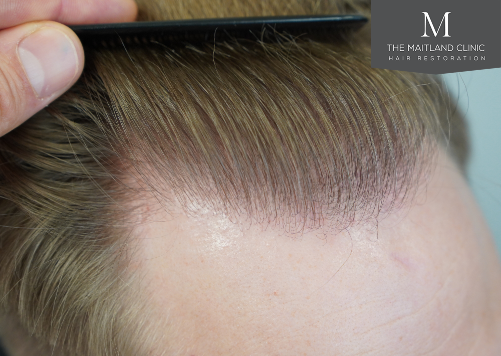 4566 grafts by FUE