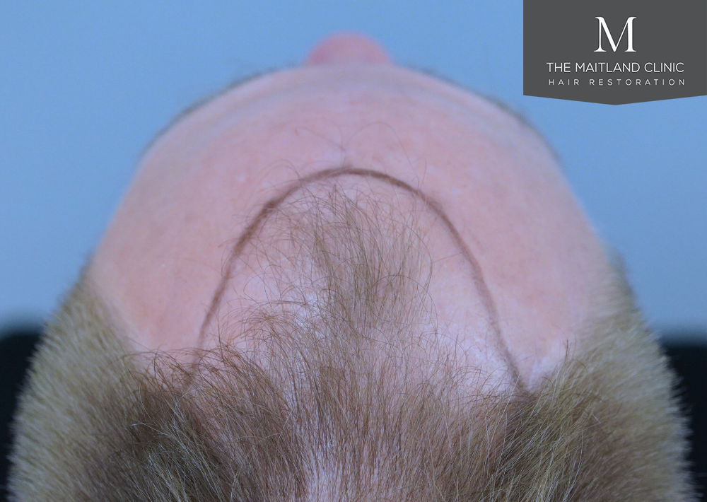 4566 grafts by FUE