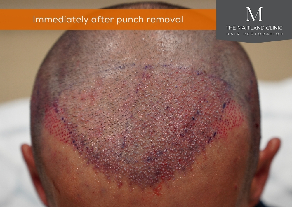 282 punches out and 667 grafts by FUE