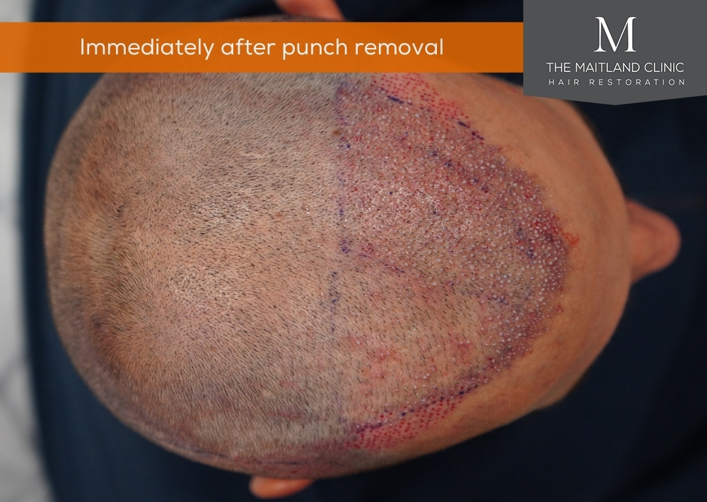 282 punches out and 667 grafts by FUE