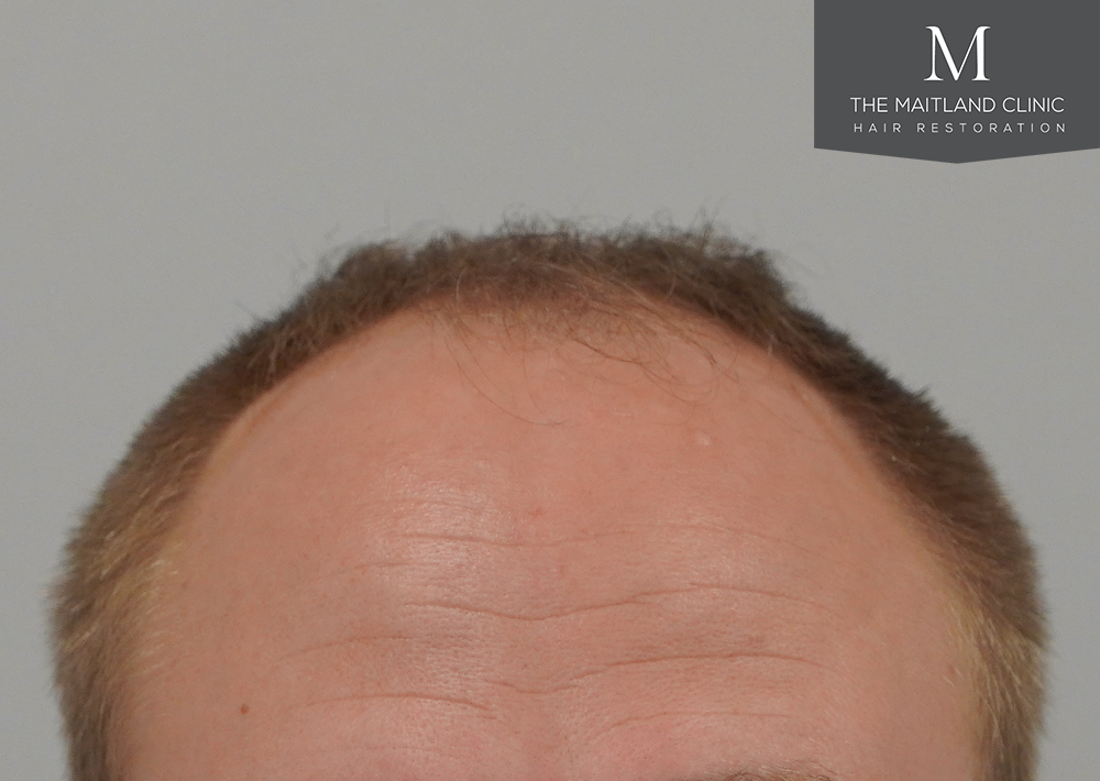 4566 grafts by FUE