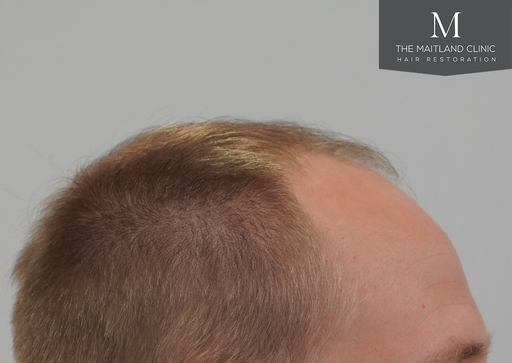 4566 grafts by FUE