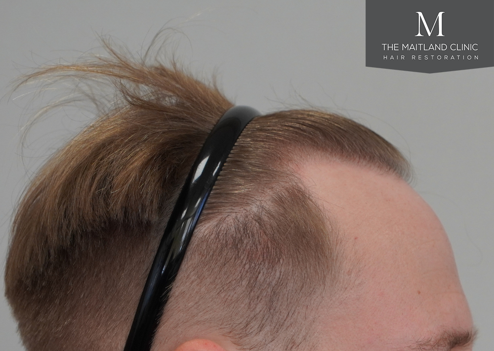 4566 grafts by FUE