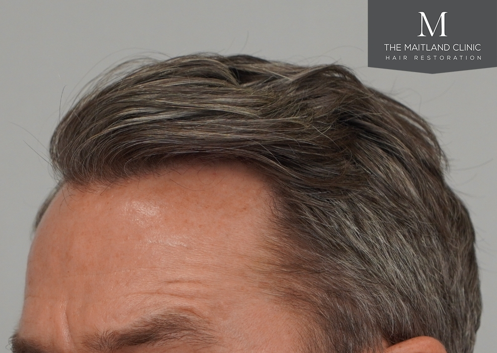 1030 grafts by FUE