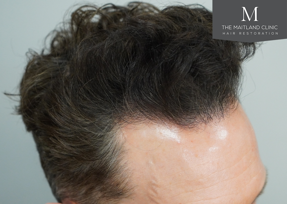 1786 grafts by FUE