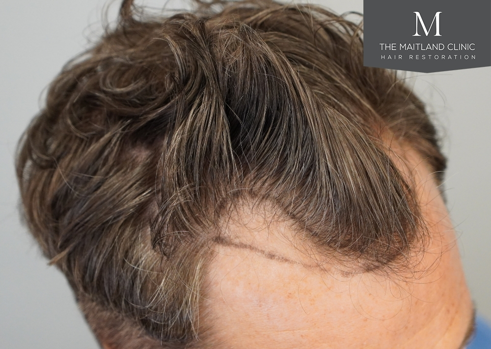 1030 grafts by FUE