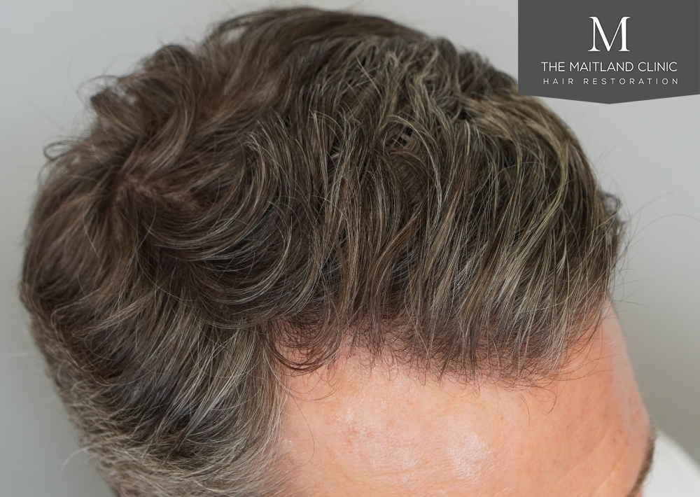1030 grafts by FUE
