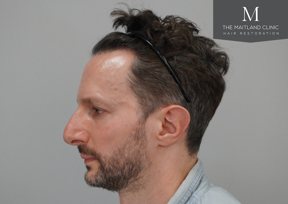 1786 grafts by FUE