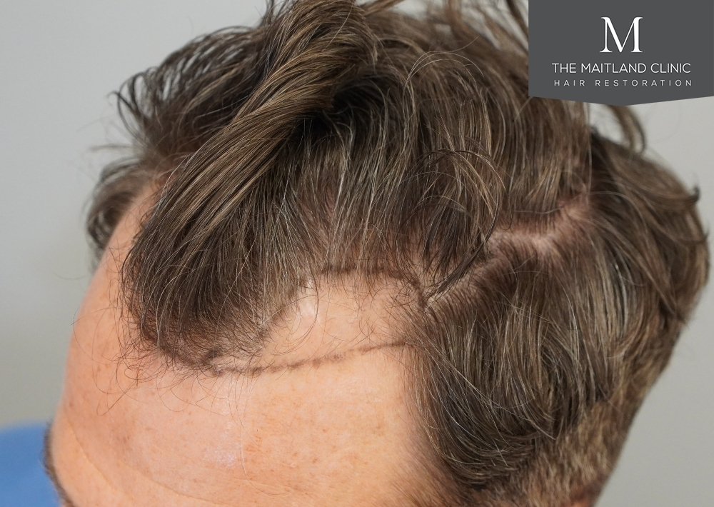 1030 grafts by FUE