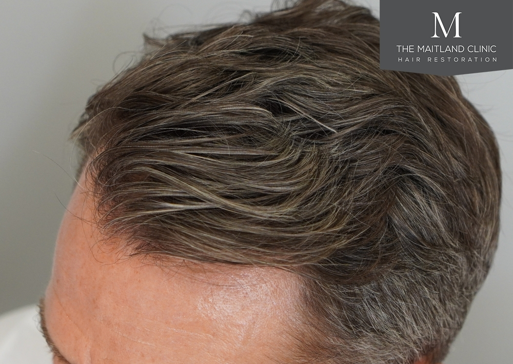 1030 grafts by FUE