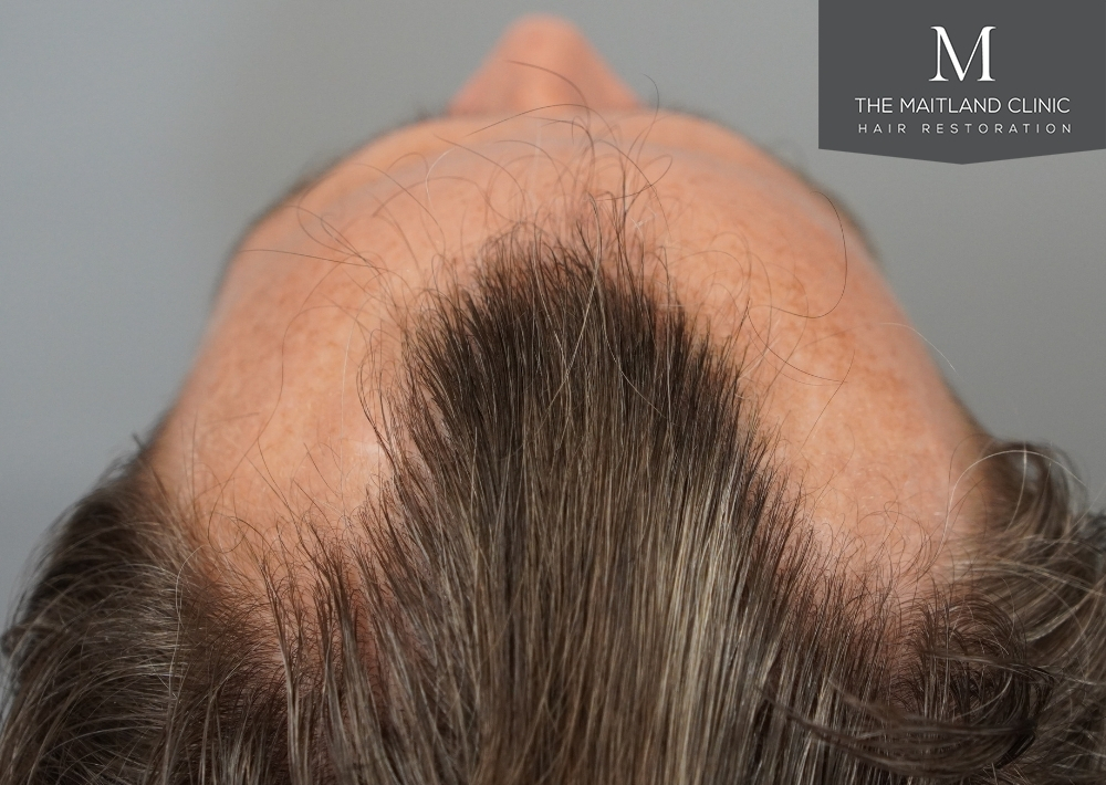 1030 grafts by FUE