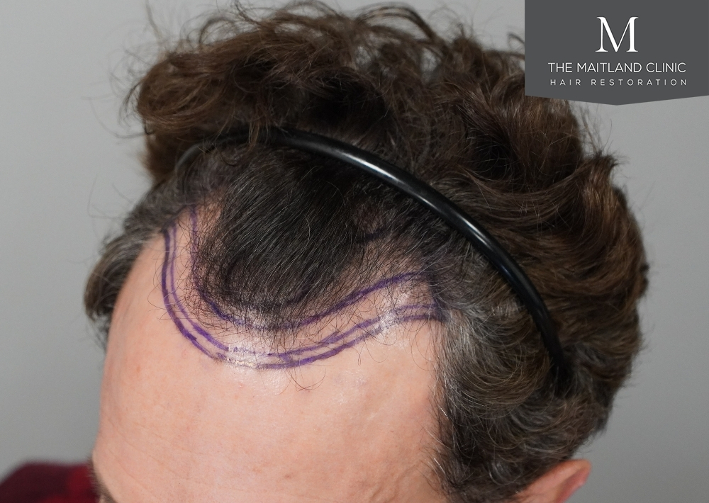 1786 grafts by FUE