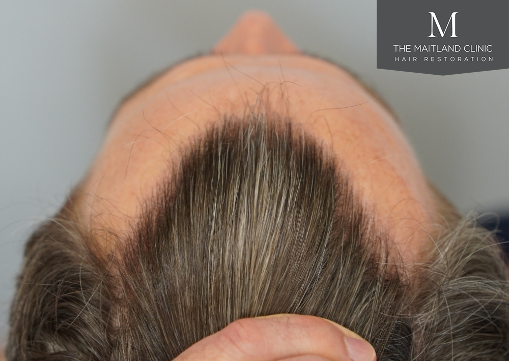 1030 grafts by FUE