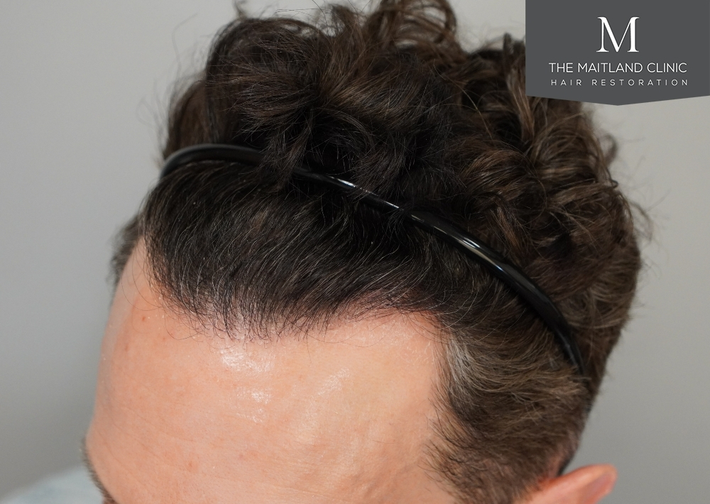 1786 grafts by FUE