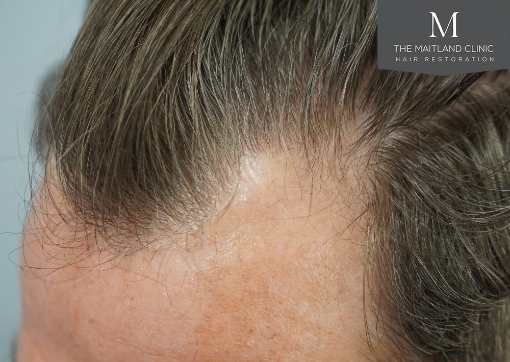 1030 grafts by FUE