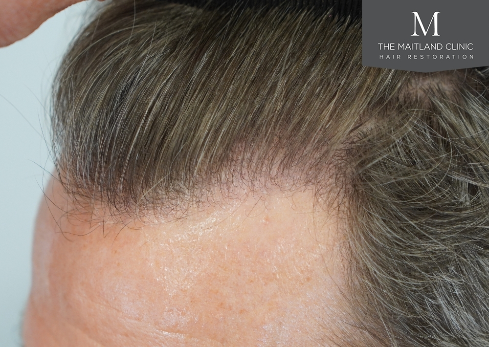1030 grafts by FUE