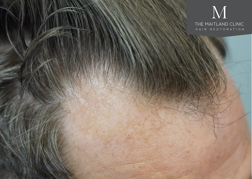 1030 grafts by FUE