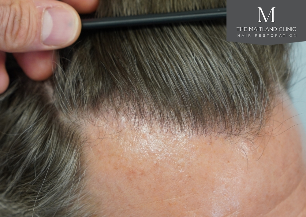 1030 grafts by FUE