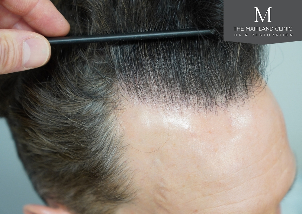 1786 grafts by FUE